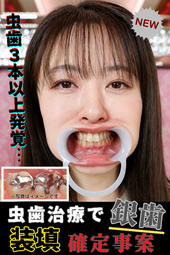 奥歯崩壊⁉即歯医者行き案件‼【虫歯3本以上…《銀歯治療確定》】栗山さつきの放置された口内鑑賞