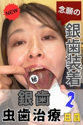 【銀歯装填確定虫歯治療2日目】『虫歯だらけで口内大炎上‼重症虫歯を大掘削！疲労困憊 栗山さんの口内救出大作戦』