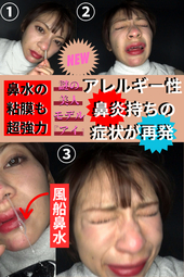 注射治療を施す程の重度な鼻炎持ちのクランケにBBM軍団はどう立ち向かう!?【鼻水風船の粘度は異常の表れ??】クシャ顔◎