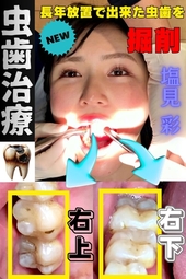 【虫歯治療】仕事に忙殺されて長年間放置された口内…塩見彩ちゃんの右上下にタービン侵入‼