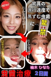 【虫歯治療２日目】嬉来には程遠い⁉たった数か月で真っ黒に進行した虫歯に奮闘する関西GALひなた♡