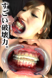 歯列矯正フェラ