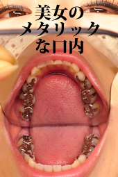 歯観察「せいこチャン編」メタル口内 写真付