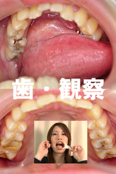 歯観察 写真付「美玲編」