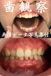 歯観察 写真付「まやチャン編」