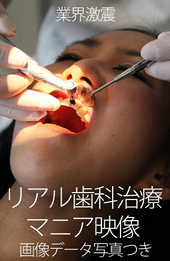 本物の歯科治療映像 えみ編