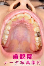 歯観察 写真付「まほチャン編」
