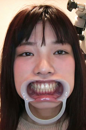 【歯科医師治療映像】痛みに耐えながらの虫歯治療【特選画像50枚付】